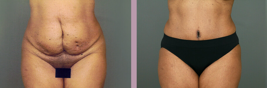 Case--15536 | Before and After Mommy Makeover 6