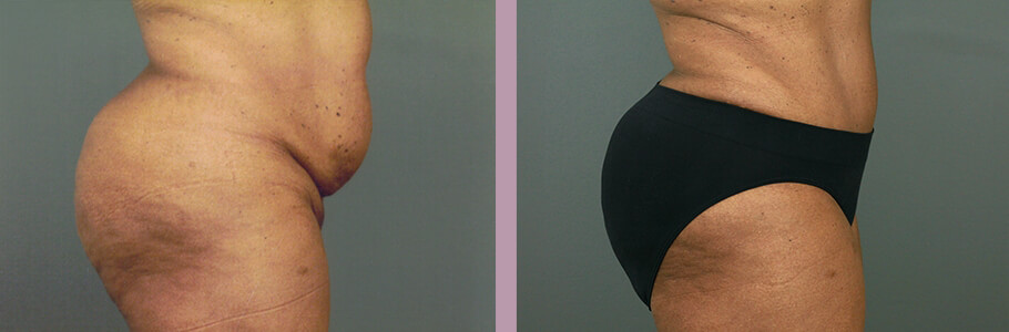 Case--15536 | Before and After Mommy Makeover 8