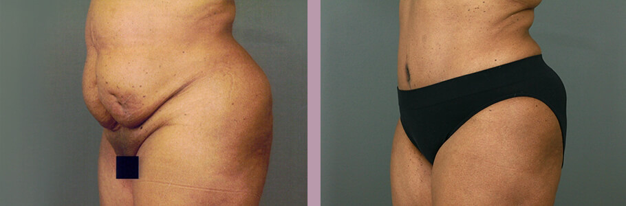 Case--15536 | Before and After Mommy Makeover 9