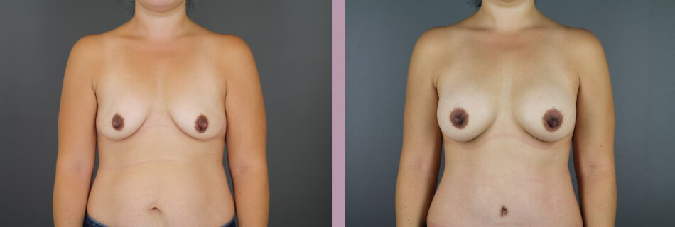 Case--16155 | Before and After Mommy Makeover