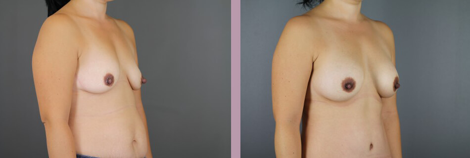 Case--16155 | Before and After Mommy Makeover 2