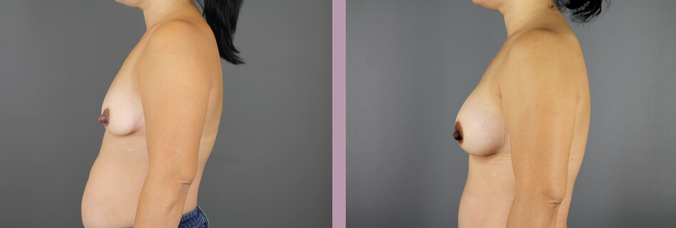 Case--16155 | Before and After Mommy Makeover 3