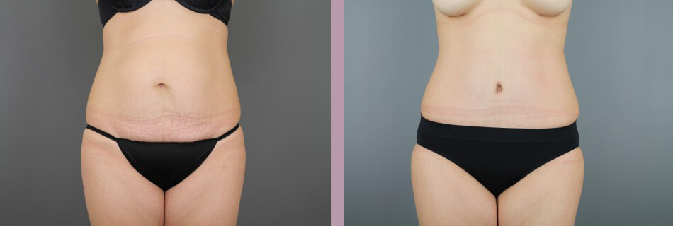 Case--16155 | Before and After Mommy Makeover 4