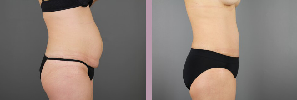 Case--16155 | Before and After Mommy Makeover 6