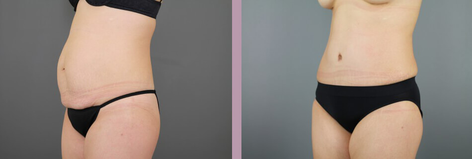 Case--16155 | Before and After Mommy Makeover 7