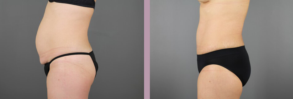 Case--16155 | Before and After Mommy Makeover 8