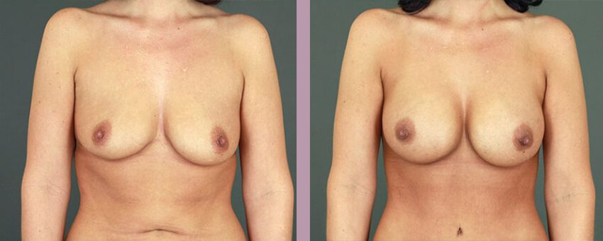 Mommy Makeover - Before and After Patient Results - 2