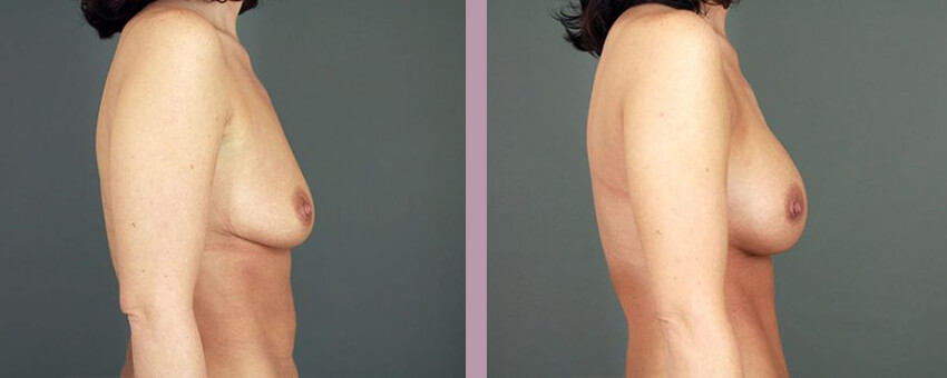 Case--16888 | Before and After Mommy Makeover 3