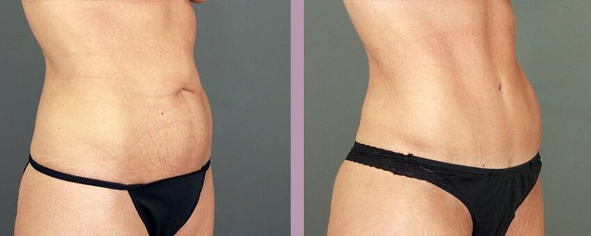 Case--16888 | Before and After Mommy Makeover 5