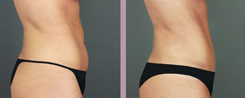 Case--16888 | Before and After Mommy Makeover 6