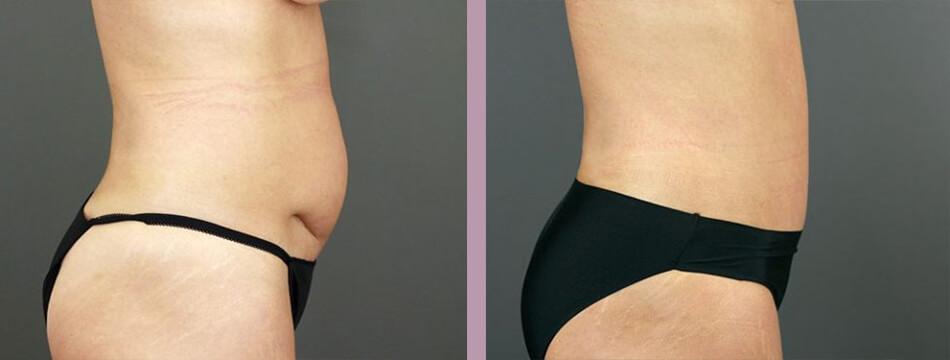 Case--16934 | Before and After Mommy Makeover 10