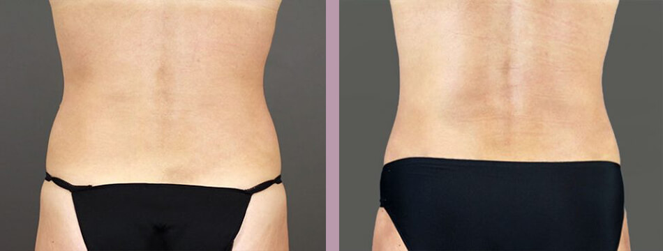 Case--16934 | Before and After Mommy Makeover 11