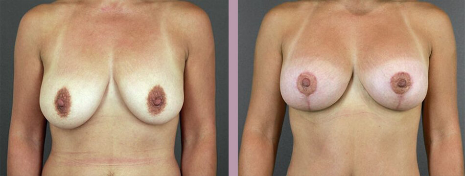 Mommy Makeover - Before and After Patient Results - 3