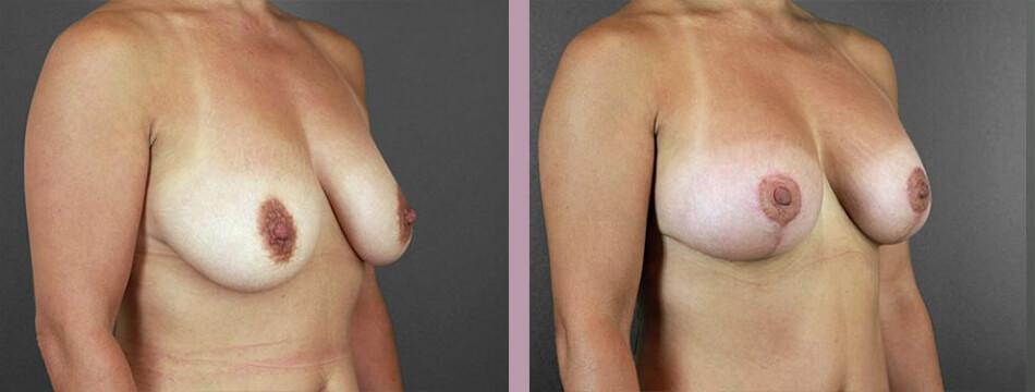 Case--16934 | Before and After Mommy Makeover 2