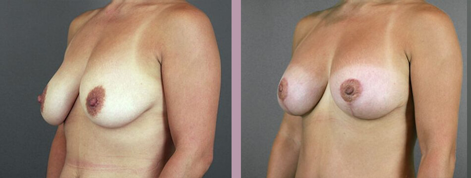 Case--16934 | Before and After Mommy Makeover 3