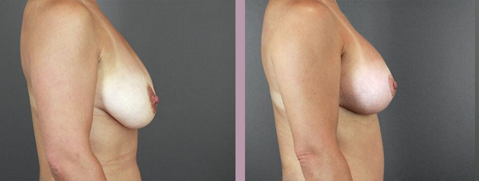 Case--16934 | Before and After Mommy Makeover 4