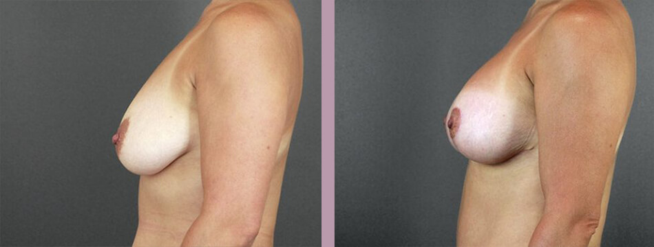 Case--16934 | Before and After Mommy Makeover 5