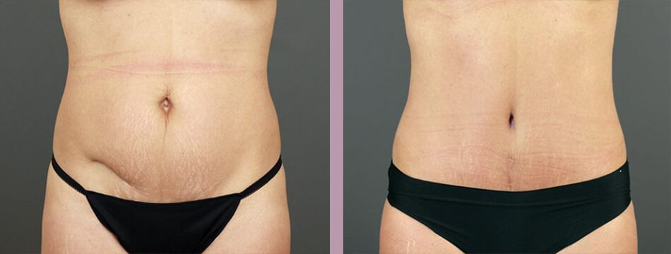 Case--16934 | Before and After Mommy Makeover 6