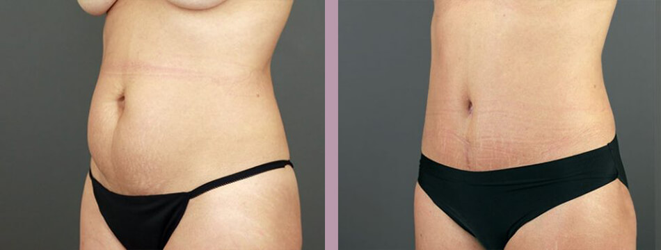 Case--16934 | Before and After Mommy Makeover 7