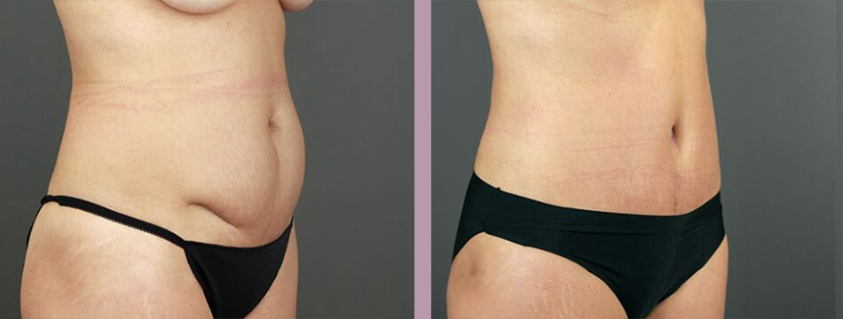 Case--16934 | Before and After Mommy Makeover 8