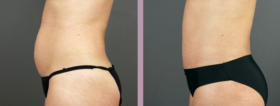 Case--16934 | Before and After Mommy Makeover 9