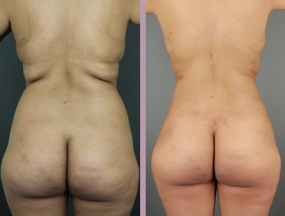 Case--17438 | Before and After Mommy Makeover 10