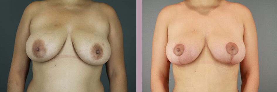 Case--17438 | Before and After Mommy Makeover