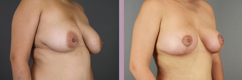 Case--17438 | Before and After Mommy Makeover 2