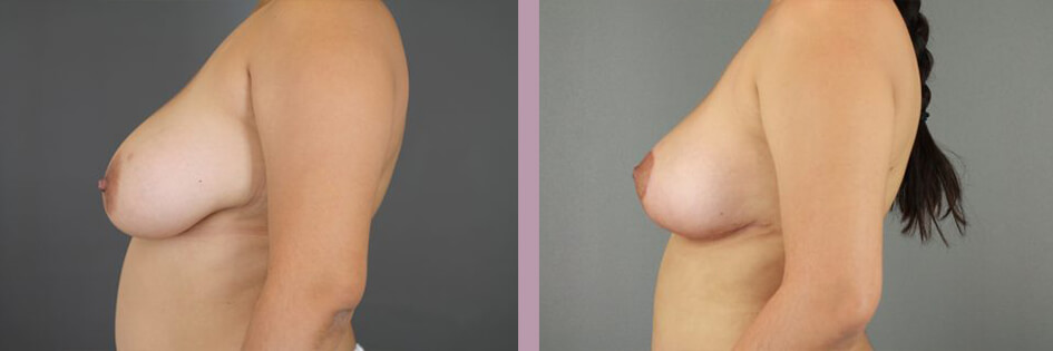 Case--17438 | Before and After Mommy Makeover 3