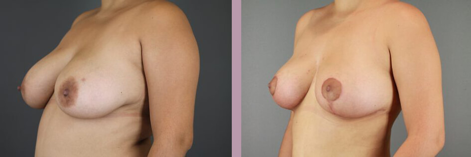 Case--17438 | Before and After Mommy Makeover 4