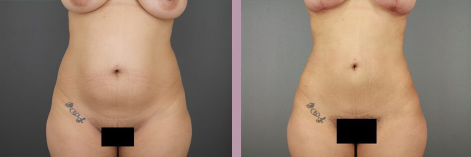 Case--17438 | Before and After Mommy Makeover 5