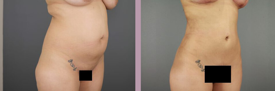 Case--17438 | Before and After Mommy Makeover 6