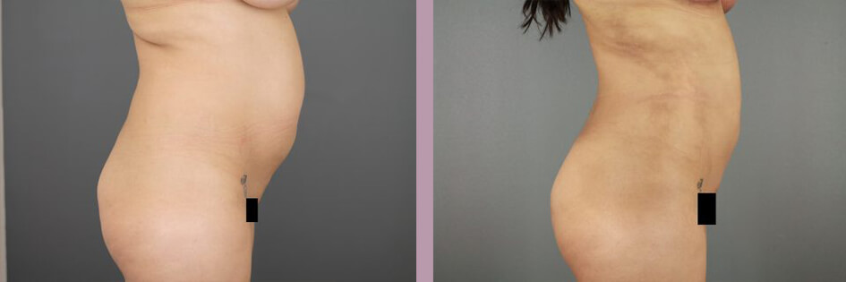 Case--17438 | Before and After Mommy Makeover 7