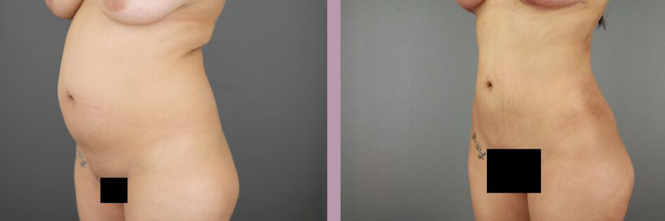 Case--17438 | Before and After Mommy Makeover 8