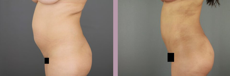 Case--17438 | Before and After Mommy Makeover 9