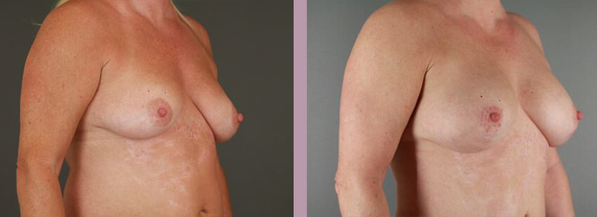 Case--17633 | Before and After Mommy Makeover 10