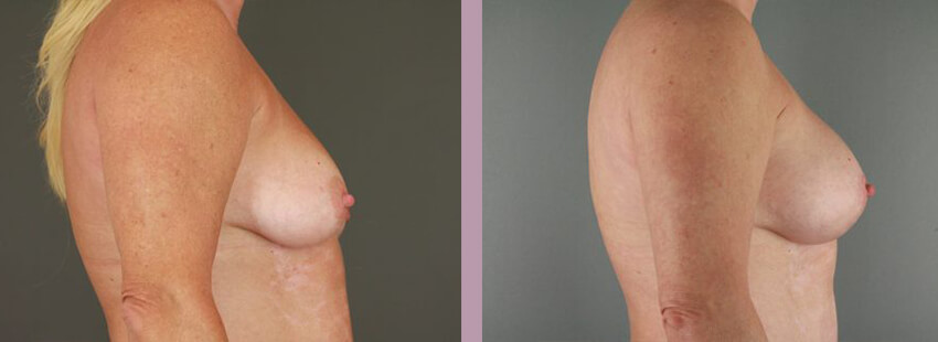 Case--17633 | Before and After Mommy Makeover 11