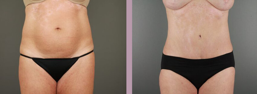 Case--17633 | Before and After Mommy Makeover