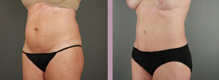 Case--17633 | Before and After Mommy Makeover 2