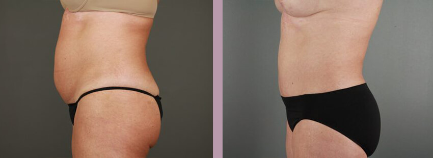 Case--17633 | Before and After Mommy Makeover 3