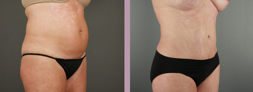 Case--17633 | Before and After Mommy Makeover 4