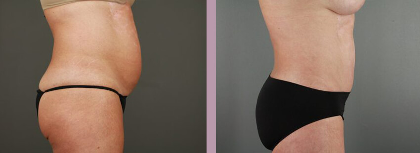 Case--17633 | Before and After Mommy Makeover 5