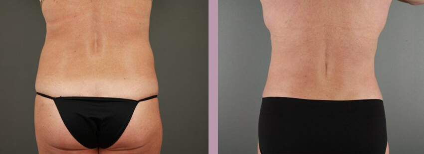 Case--17633 | Before and After Mommy Makeover 6