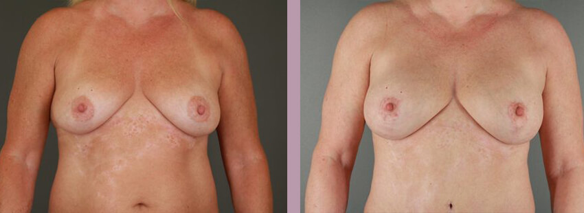 Case--17633 | Before and After Mommy Makeover 7