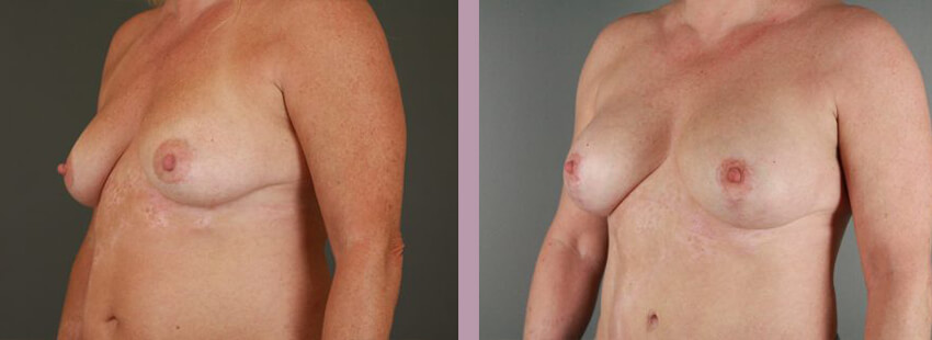 Case--17633 | Before and After Mommy Makeover 8