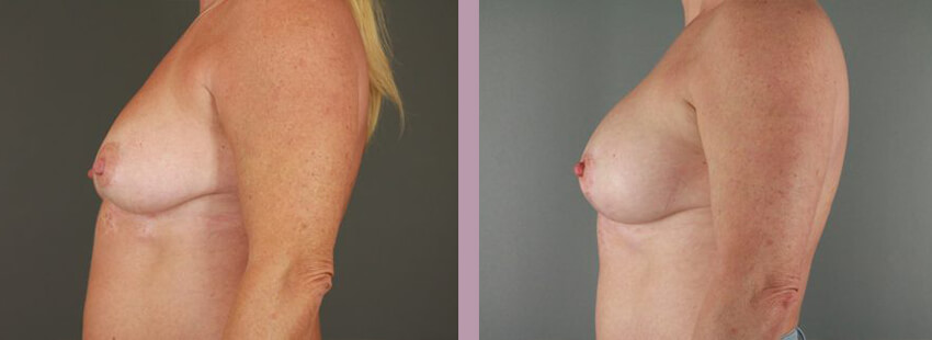 Case--17633 | Before and After Mommy Makeover 9