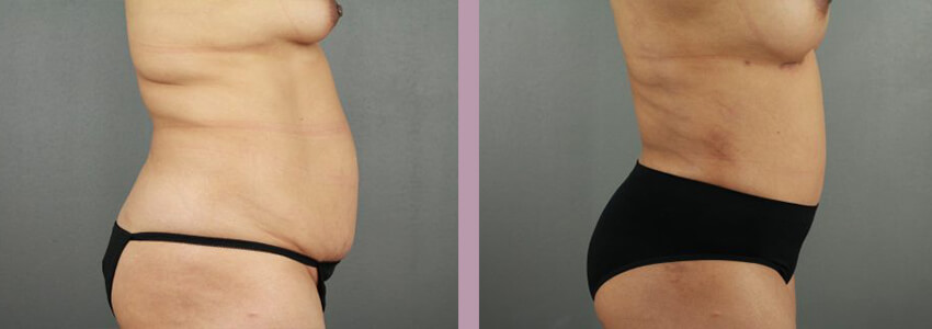 Case--18035 | Before and After Mommy Makeover 10