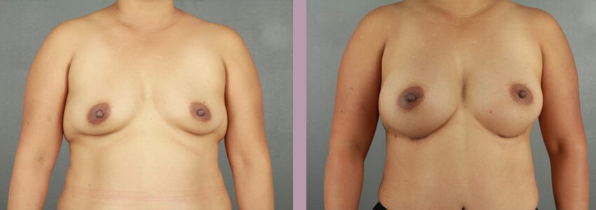 Case--18035 | Before and After Mommy Makeover