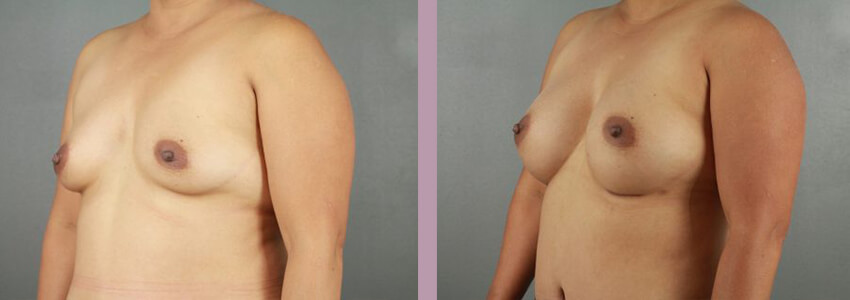 Case--18035 | Before and After Mommy Makeover 2