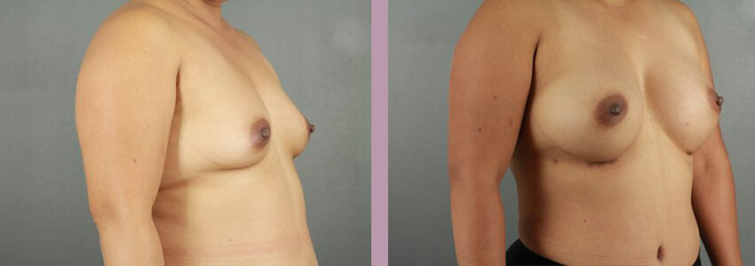 Case--18035 | Before and After Mommy Makeover 4